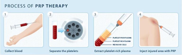 Process of PRP